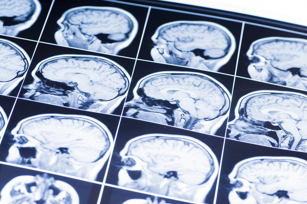 Can I Recover Damages for a Traumatic Brain Injury in California?